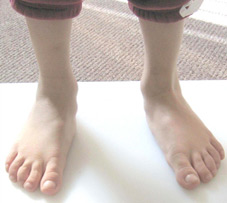 Foot Functional Orthopedics | Treatment Of Foot Fungus