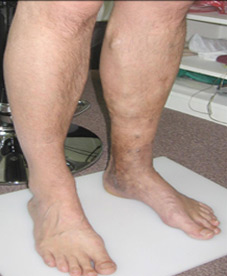 Foot Functional Orthopedics | Treatment Of Foot Fungus